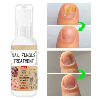 Toenail Fungus Treatment and Repair, Effective Fingernail and Toenail Repair Hydrates