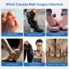 Picture of Toenail Fûngus Treatment Extra Strength 16PCS,Toenail Fûngus Treatment for Repairing Faded or Damaged Toenails,and Restores a Healthy Appearance of Toenails